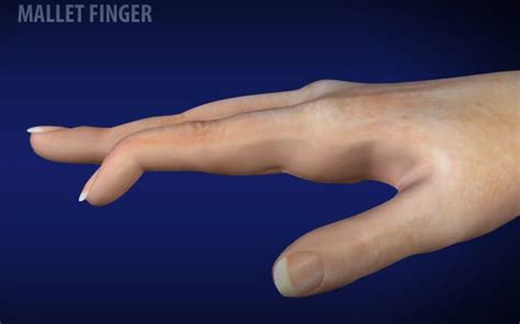 Mallet Finger: What It Is, Causes, Symptoms & Treatment